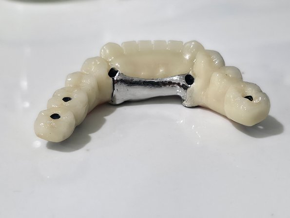 Full Mouth Rehabilitation treatment