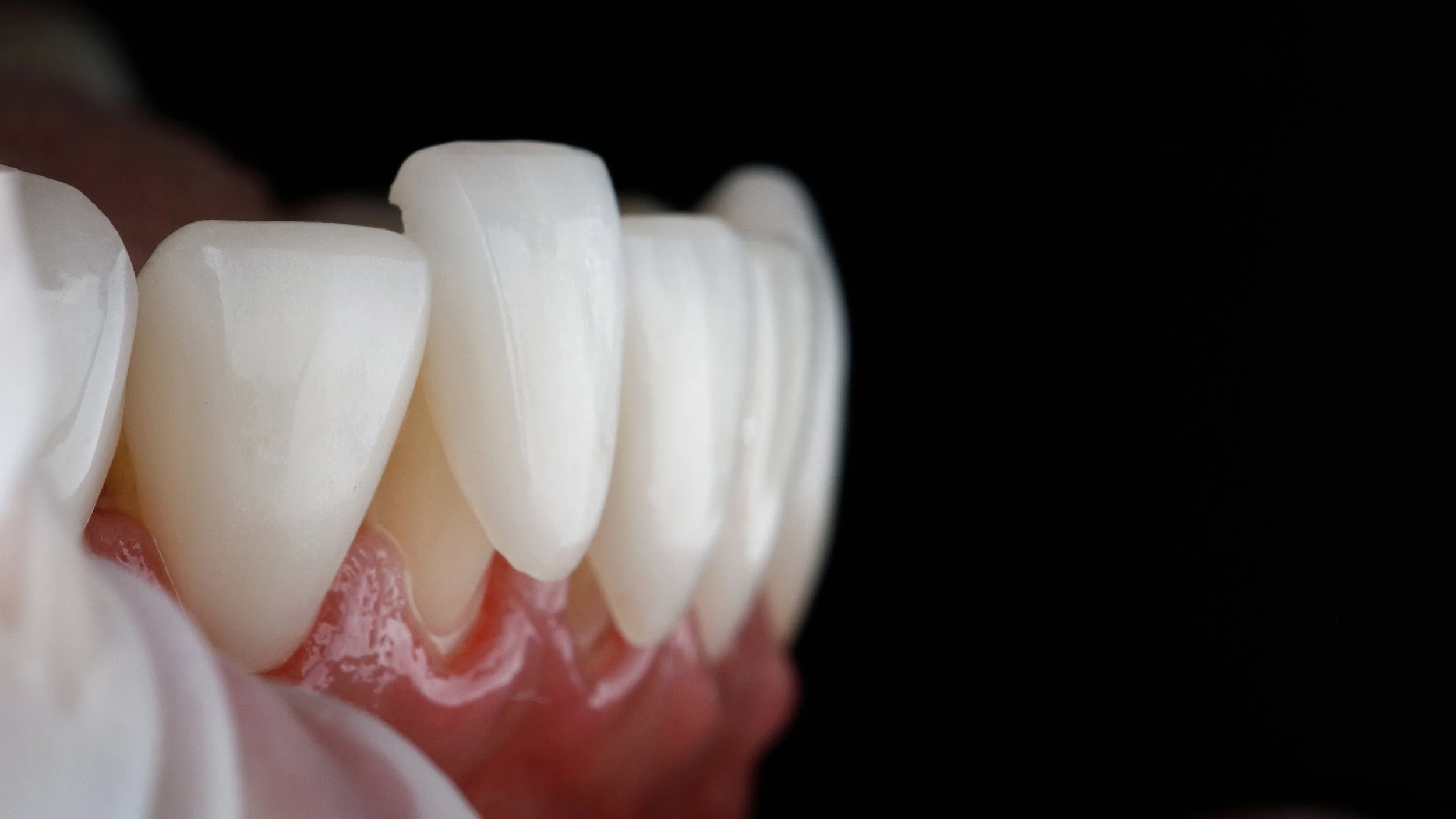 Dental Veneers