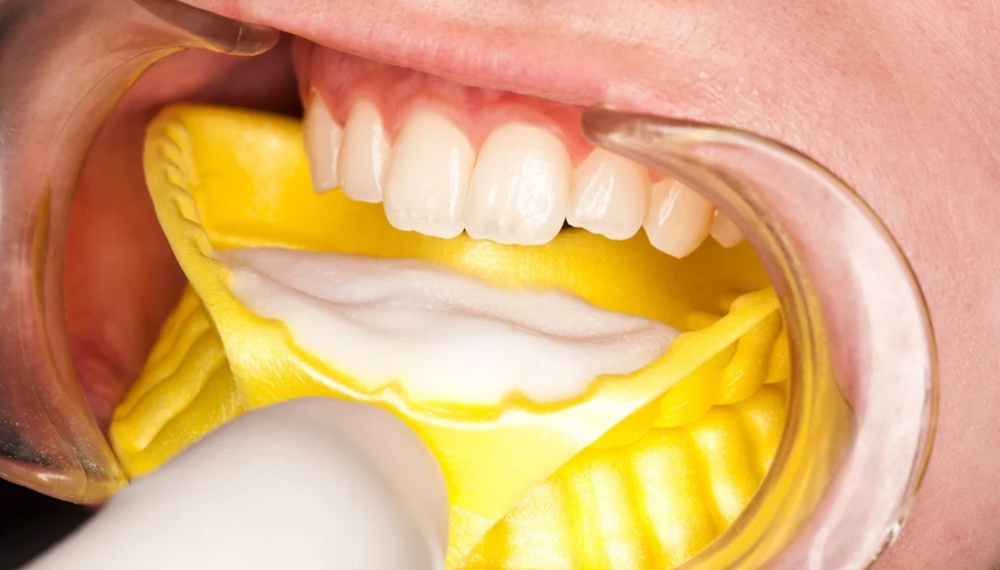 Fluoride Treatment
