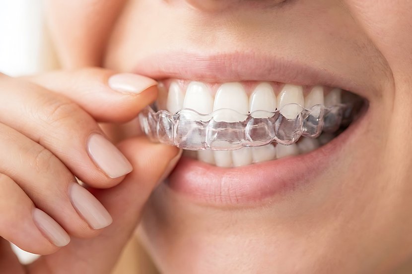 Invisalign for Teens overview