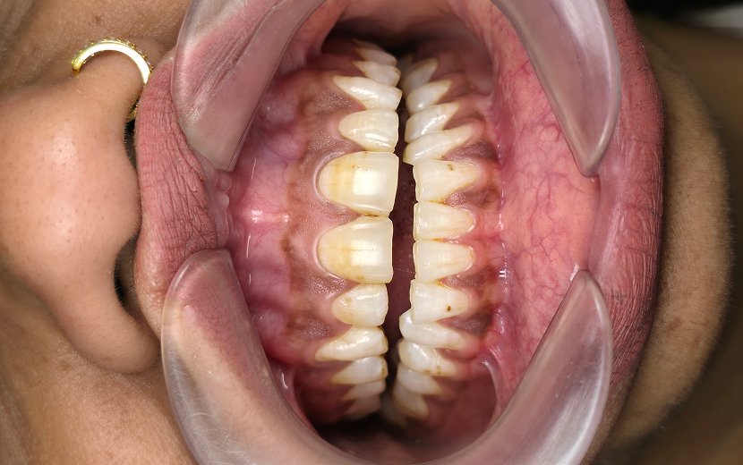 Teeth Whitening
